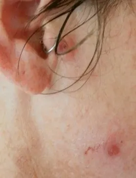 nasal impetigo