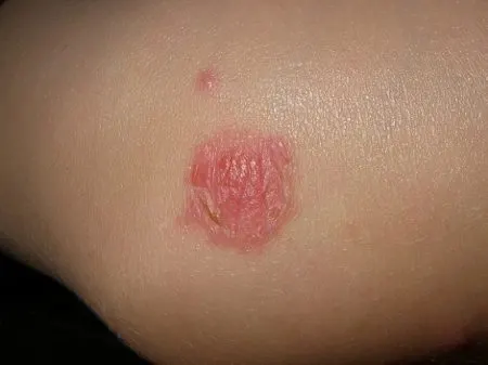 School sores take weeks to heal with antibiotics and antibiotic creams. This one is almost healed.